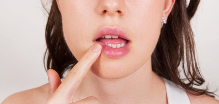 herpes labiale cause contagio rimedi naturali e cura veloce