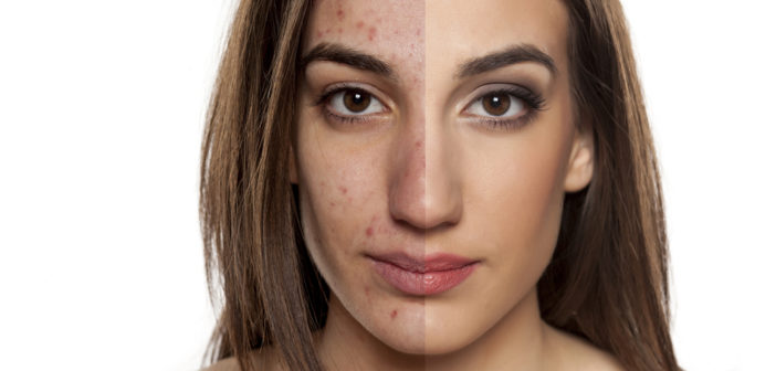 cicatrici da acne rimedi naturali