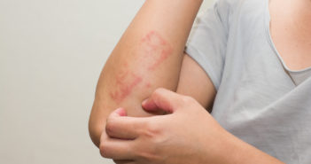 Psoriasi: cause, sintomi e rimedi naturali
